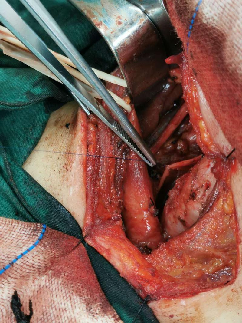 首例喉返神經(jīng)手術(shù)圖片.jpg 首例喉返神經(jīng)手術(shù)圖片.jpg