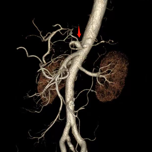 紅色箭頭所指為動(dòng)脈瘤.png 紅色箭頭所指為動(dòng)脈瘤.png